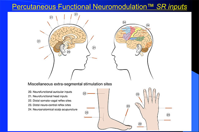 The Percutaneous Functional Neuromodulation™ SR Inputs The Percutaneous Functional Neuromodulation™ SR Inputs