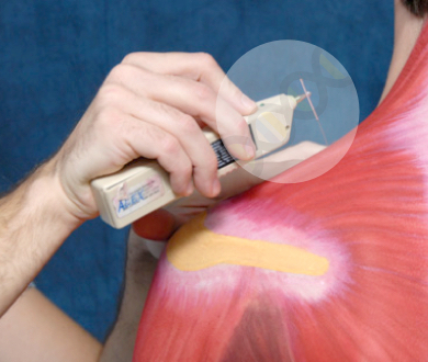 Adverse reactions attributable to acupuncture