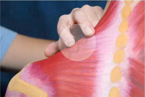 What is Neurofunctional Acupunture